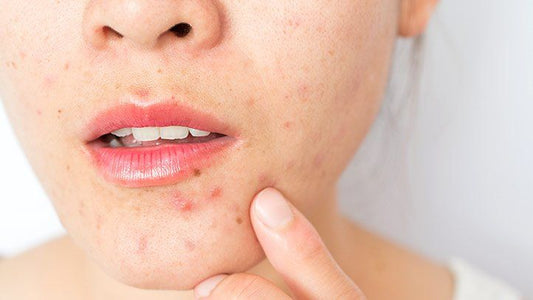Simple Tips for Acne Problems with these Home Remedies