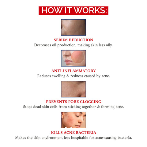 AKNOZAP Softgel Capsules with Isotretinoin - 20mg